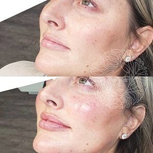 Dermal Fillers Gallery Before & After