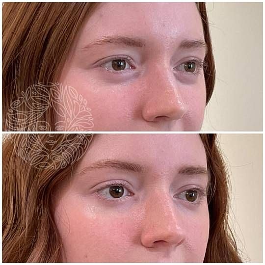 Botox Gallery Before & After