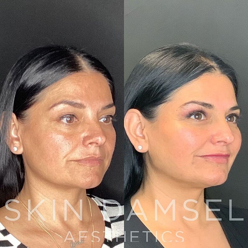 Bio Fillers Gallery Before & After