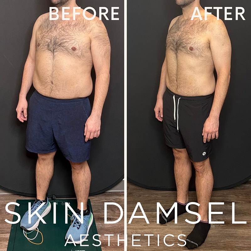 Semaglutide Gallery Before & After