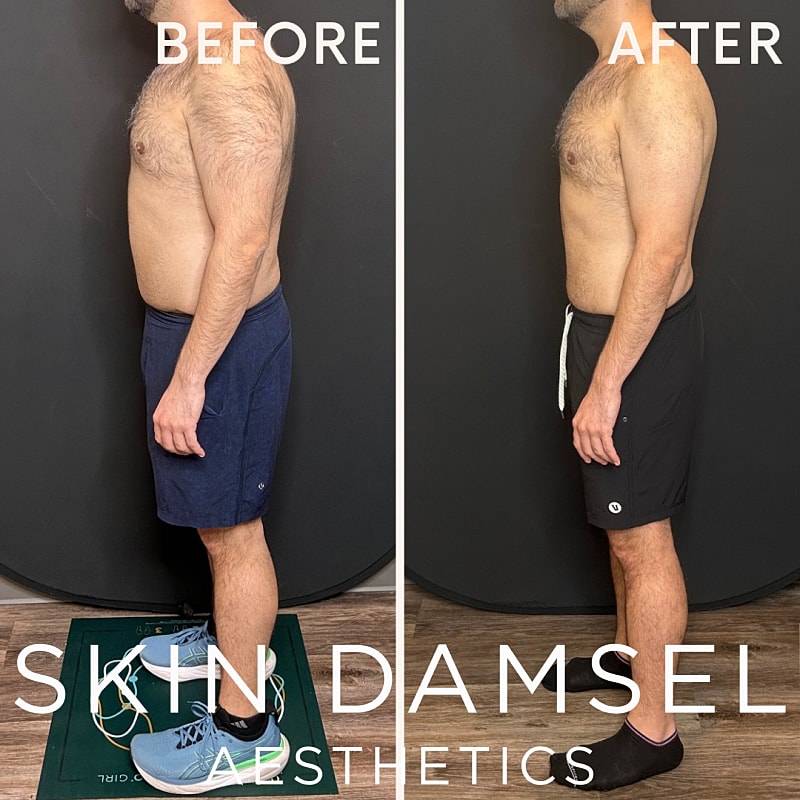 Semaglutide Gallery Before & After