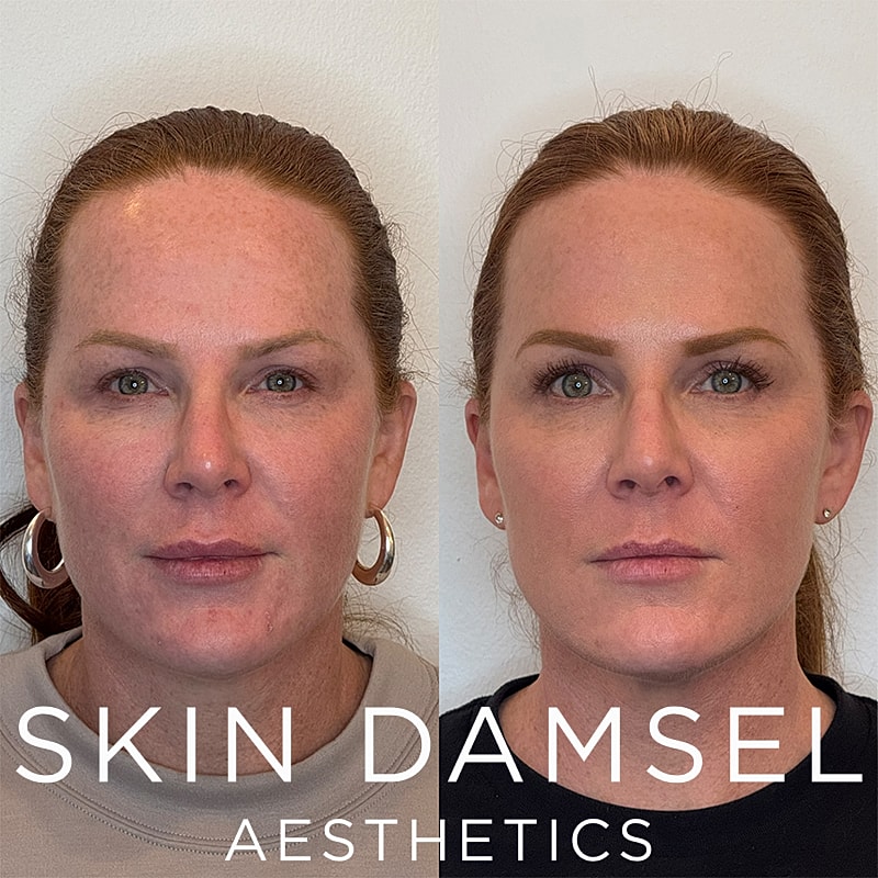 BBL Laser Gallery Before & After