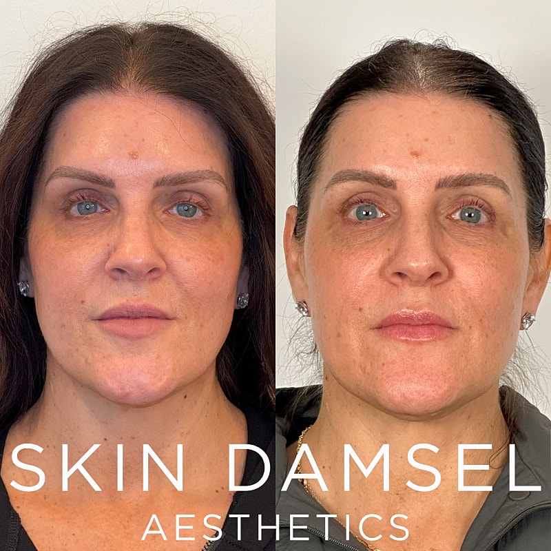 BBL Laser Gallery Before & After