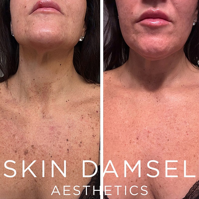 BBL Laser Gallery Before & After