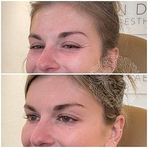 Dysport Gallery Before & After