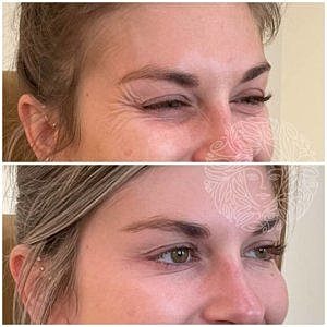 Dysport Gallery Before & After