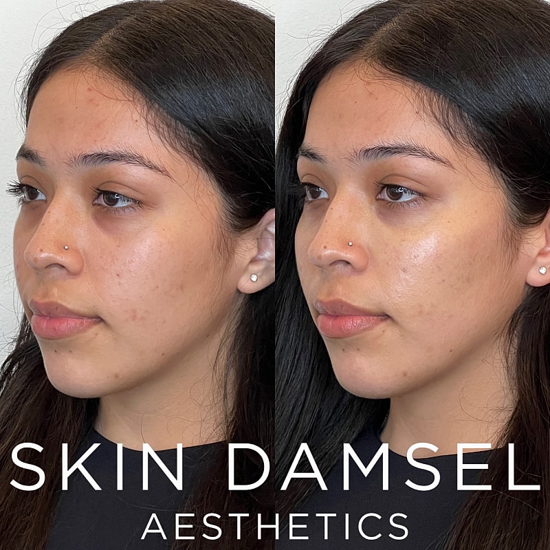 Tear Trough Filler Gallery Before & After