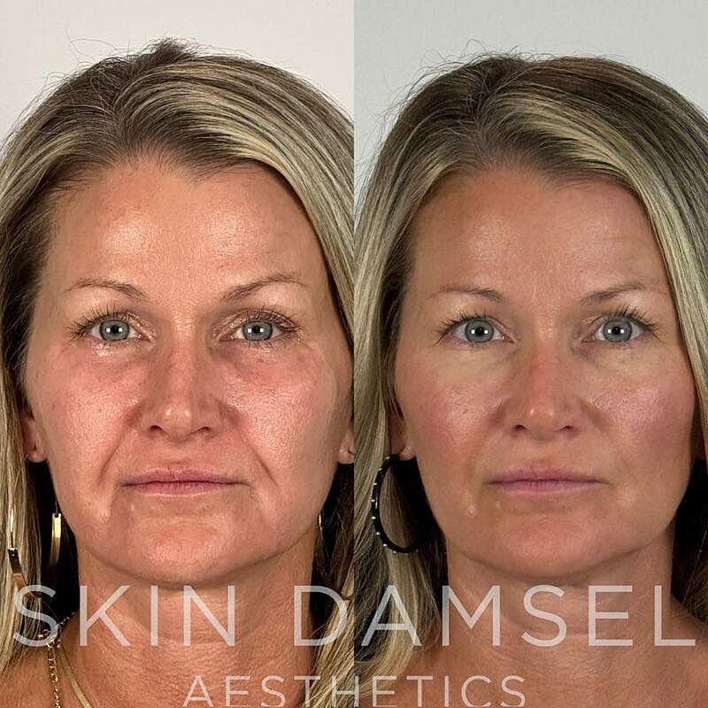 Tear Trough Filler Gallery Before & After