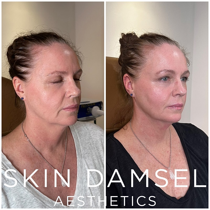 Neffrettiti Before & After