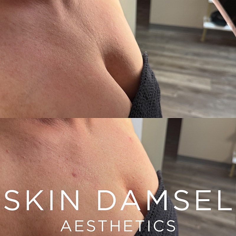 Declotage Gallery Before & After