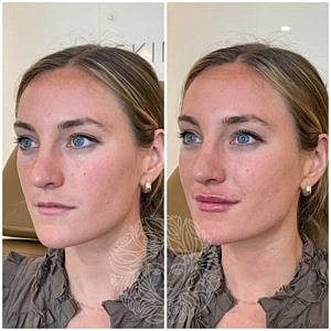 Lip Filler Gallery Before & After