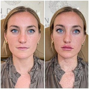Lip Filler Gallery Before & After