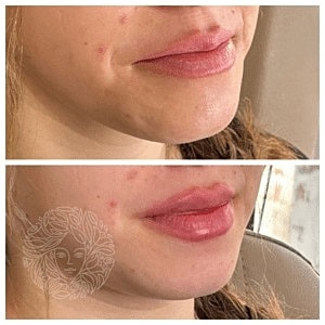 Lip Filler Gallery Before & After