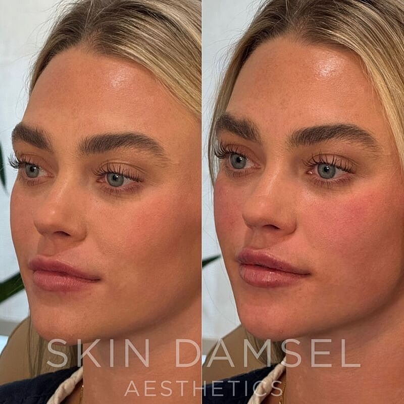 Lip Filler Gallery Before & After