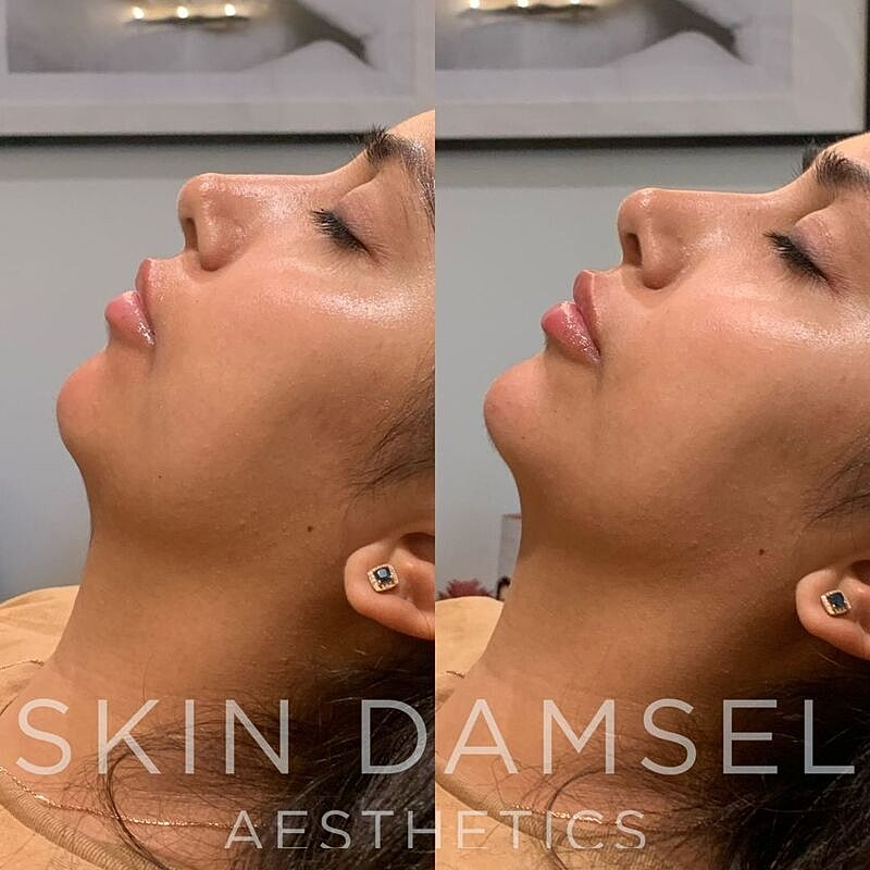 Lip Filler Gallery Before & After