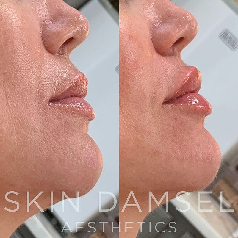 Lip Filler Gallery Before & After
