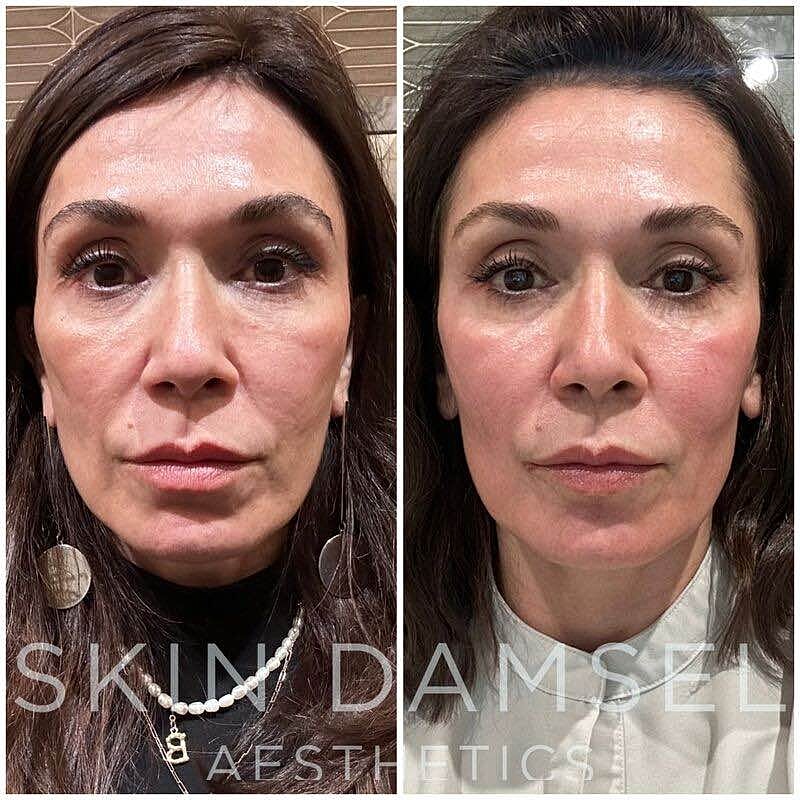 Facial Balancing Gallery Before & After
