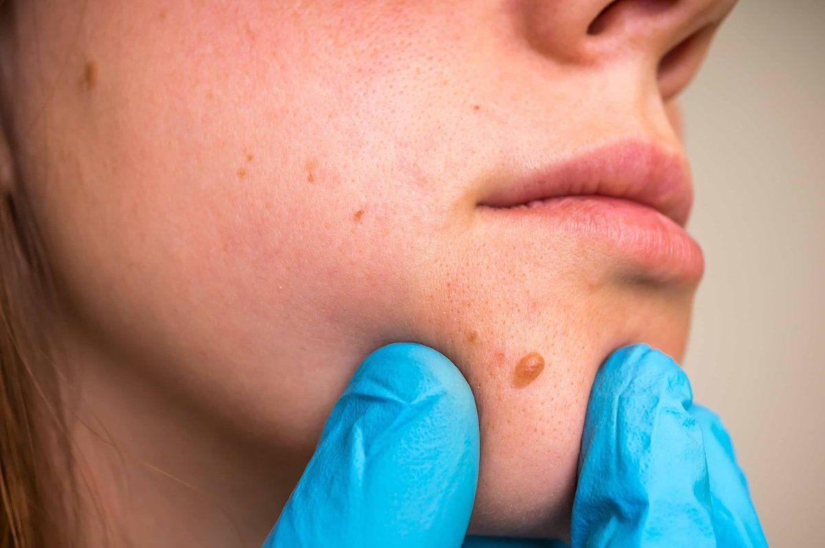 WHICH SKIN TAG REMOVAL METHODS WORK?